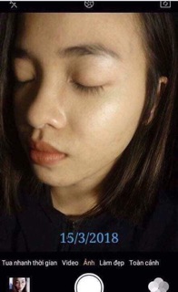Kem lành thâm sẹo mụn Smoothe