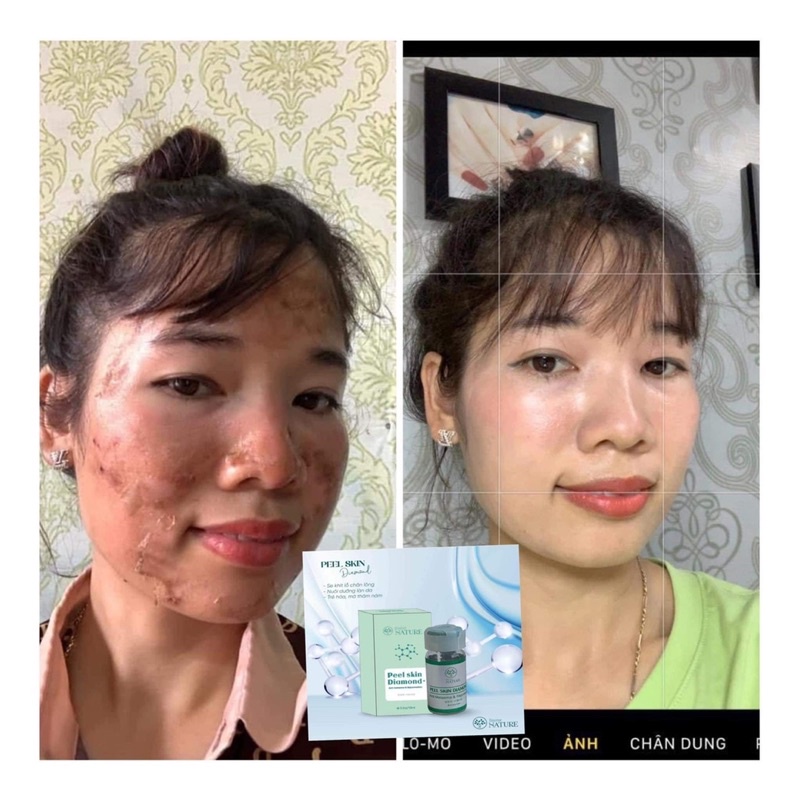 QUÉT NÁM  DR.Nature Peel skin Diamond(tái tạo trẻ hoá da,sáng căng bóng,mờ thâm nám xạm,nhỏ lcl,dùng mọi loại da,...