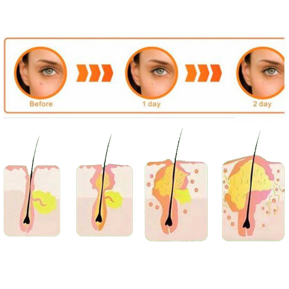 【COD】 Acne Patch &amp; Skin Tags Beauty Set Remover Pimple Master Patch Treatment 【Beeu】