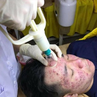Bộ giác hơi hút mụn viêm, máu độc ...