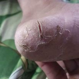 (Hộp 20 Sáp) nứt gót chân Thái Lan