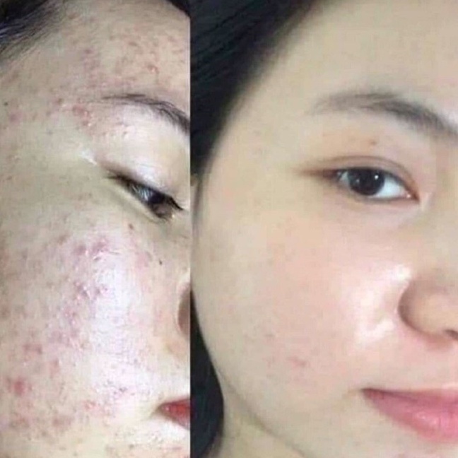 Serum giảm mụn mờ thâm- kamel Detox acnes 10ml, mĩ phẩm giảm thâm mụn