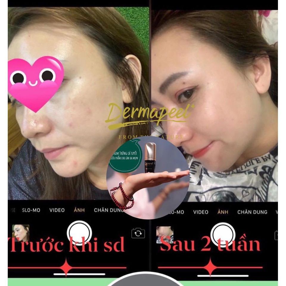 Serum Trứng Cá Tuyết Dermapeel+ 7ml - Sạch Mụn - Kiểm Soát Nhờn - Se Khít Lỗ Chân Lông - Chống Lão Hóa - Trắng Sáng | BigBuy360 - bigbuy360.vn