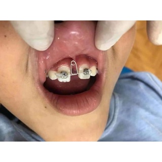 Sản phẩm Combo loop đóng khoảng răng cửa và 2 mắc cài răng cửa
