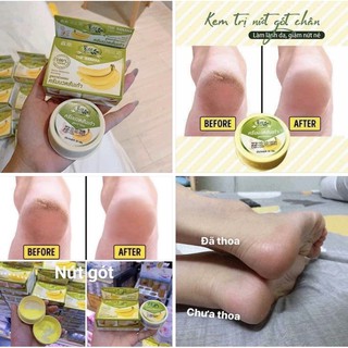 Kem giảm nứt gót chân chuối Thái Lan