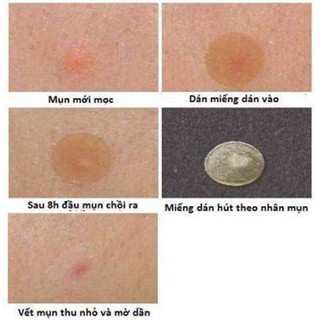 Miếng dán mụn cấp tốc Mayan Care 20 miếng và 12 miếng