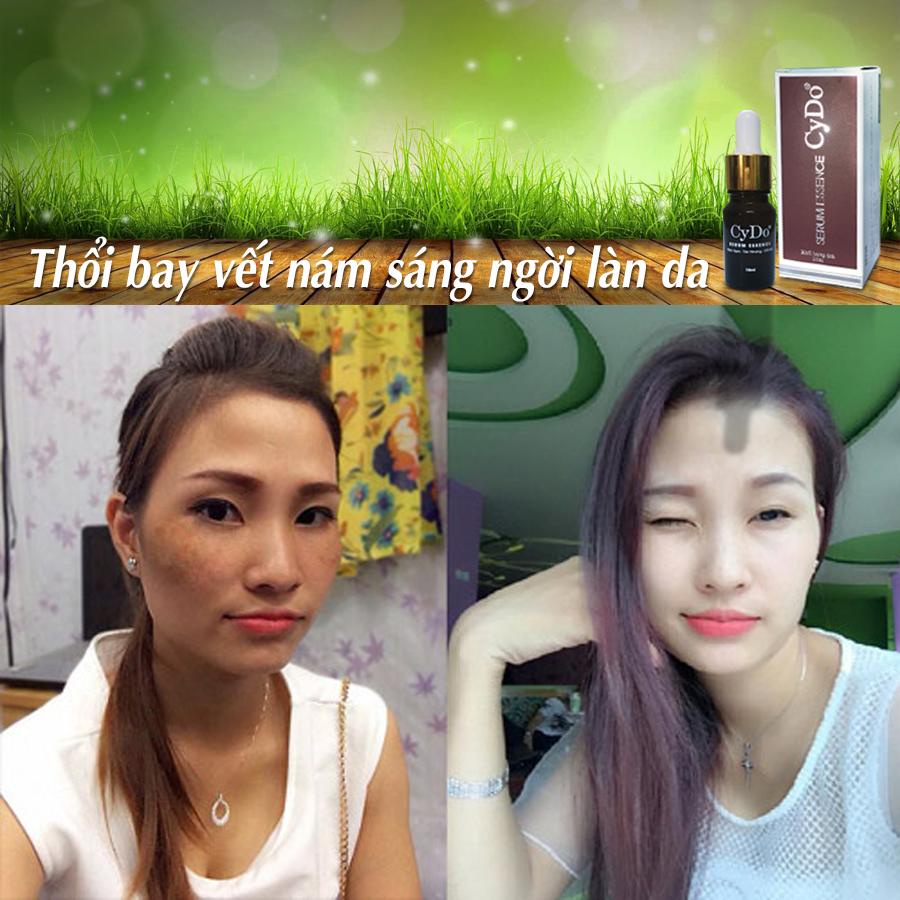 Serum Nám Sạm - Tàn Nhang - Đồi Mồi - Dưỡng Trắng Da CyDo 10ml