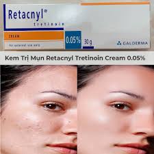 Gel Bôi Mụn RETACNYL - Tretinoin Cream 30g chính hãng