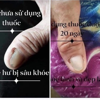 Dung Dịch Nấm Móng ,Phục Hồi Móng Hư Tổn (1 chai)