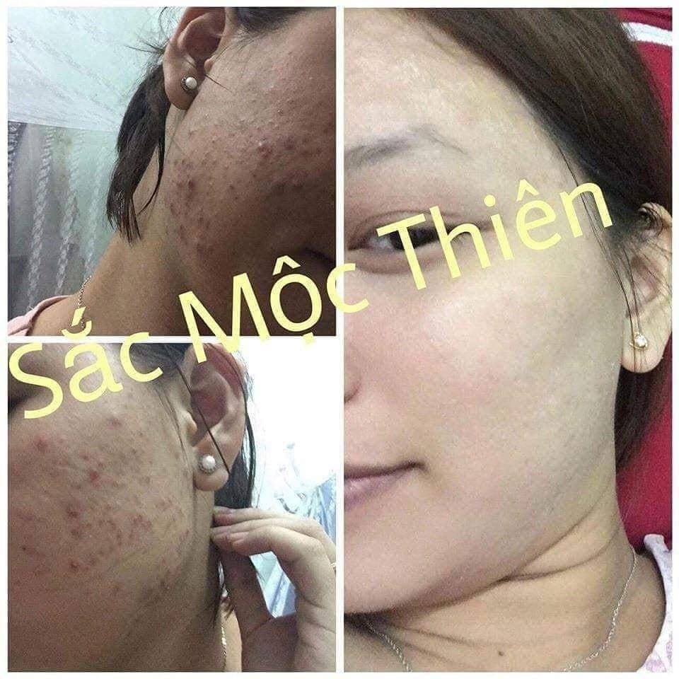 SẮC MỘC THIÊN COMBO SIÊU TỐC - LINH CHI MỘC & TÁI TẠO DA SIÊU TỐC CHÍNH HÃNG