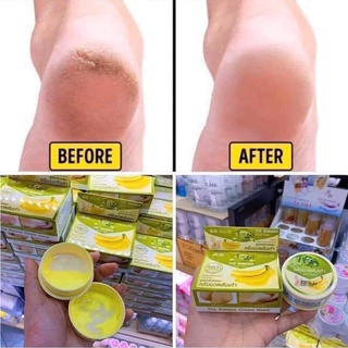 Kem xóa nứt gót chân chuối Thái Lan