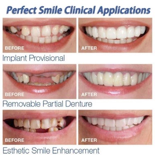 Veneers silicon mềm tạm thời giả trên