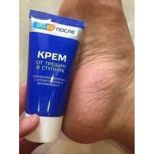 KEM TRI NỨT GÓT CHÂN NGA