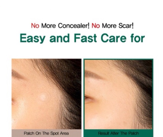 [Chính Hãng] Combo 5 Gói Dán Mụn Some By Mi Clear Spot Patch | BigBuy360 - bigbuy360.vn