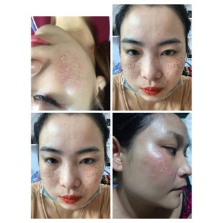SÉT LẺ TCA CHẤM TÀN NHAN, SẸO RỔ