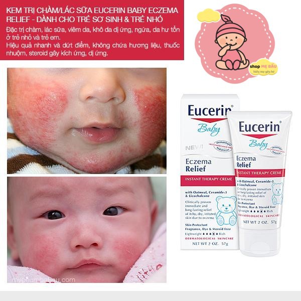 Kem dưỡng ẩm và trị chàm Eucerin