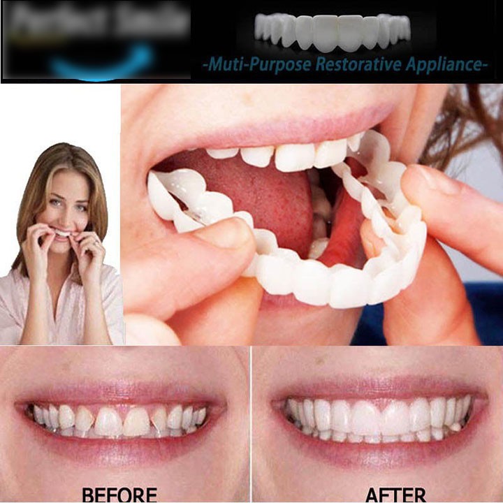 Dụng cụ niềng răng tại nhà snapon smile