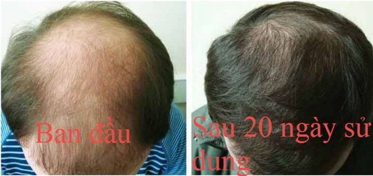 Tinh chất serum kích thích mọc râu, tóc , lông mày Snor Thái Lan