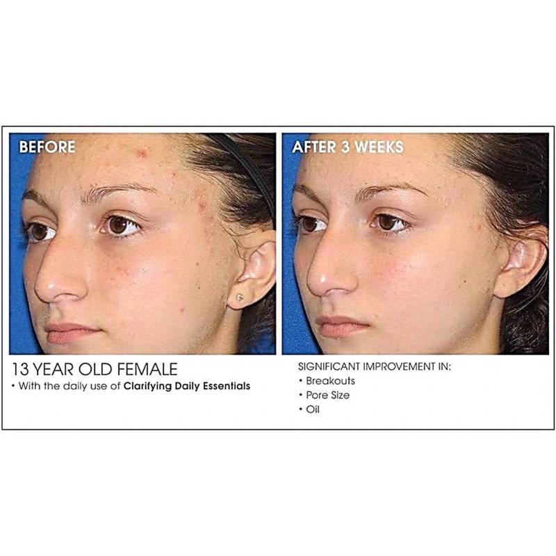 Tinh chất giảm mụn tẩy tế bào chết 1% BHA 2% AHA 1% Zinc PCA kẽm