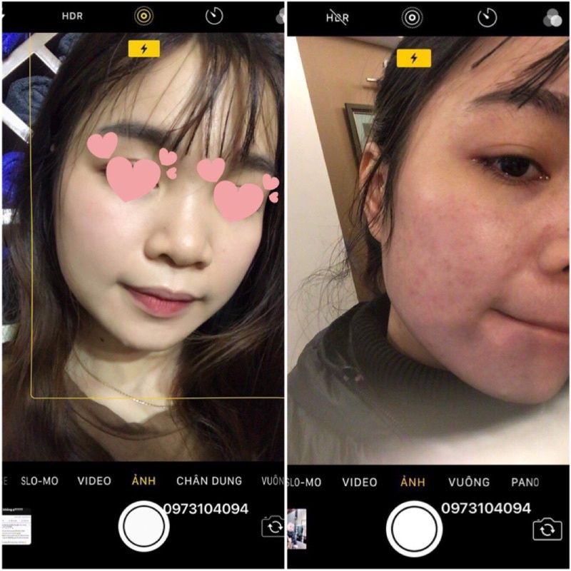 Serum mụn Nhà Bơ