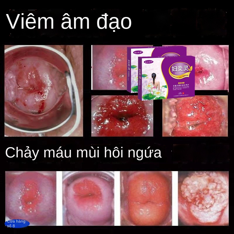 ☸✣❁Gel phụ khoa xói mòn cổ tử cung, ngứa, nấm mốc, viêm âm đạo, rong huyết, có mùi hôi, ngứa, se khít âm đạo, chăm sóc v