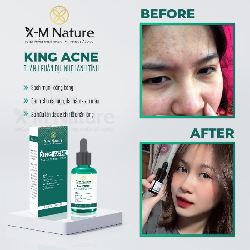 Srum mụn king acne