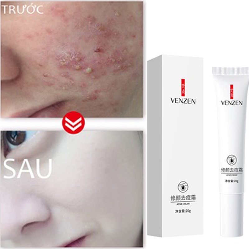 VEZE Kem giảm thâm mụn,liền sẹo, nam, nữ,ngăn ngừa mụn,giảm dầu,mau lành vết thương 20g