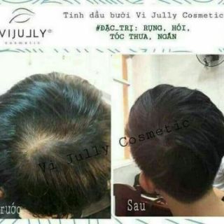 Combo 10 Chai Tinh Dầu Bưởi Trị Rụng Tóc