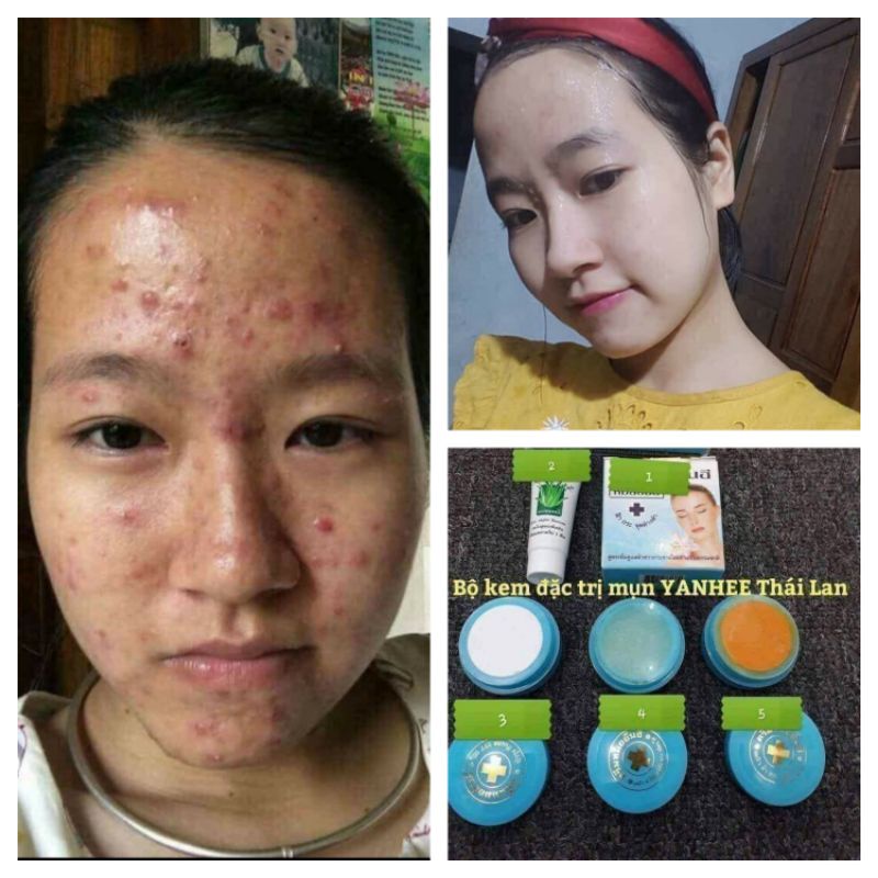 KEM YAHEE, XÓA MỤN,THÂM,NÁM,TÀN NHANG