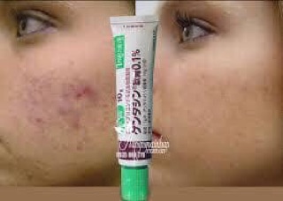 Kem trị sẹo Gentacin Nhật Bản