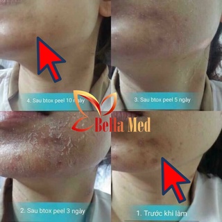 [Mã COSBAUH3 giảm 8% đơn 300K] THAY DA SINH HỌC BTOX PEEL 2 MÀU