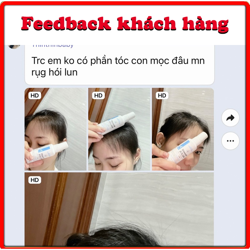 Mọc Tóc Nhanh Chóng - An Toàn. Lọ Xịt Minoxidil Bailleul 2% - Nhập khẩu Pháp. Giảm Rụng Tóc Và Kích Thích Mọc Tóc