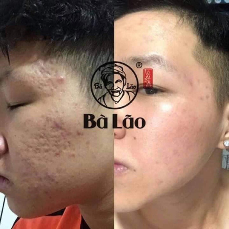 SERUM MỤN THÂM SẸO NÁM CAO CẤP-BÀ LÃO