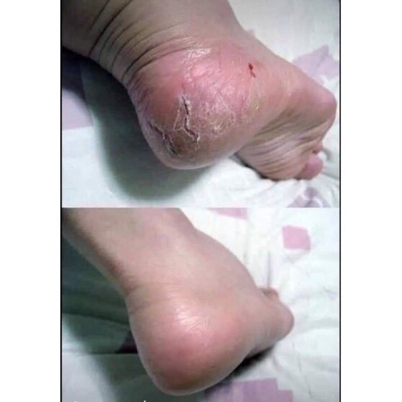 Kem nứt gót chân Kpem Apteka Nga bổ sung vitamin E và các dưỡng chất cho gót chân mềm mại tuýp 50ml