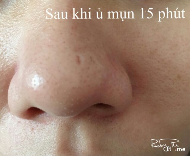 👋 Tinh chất ủ mụn YOUNGER mẫu mới 2022 hàng CHÍNH HÃNG