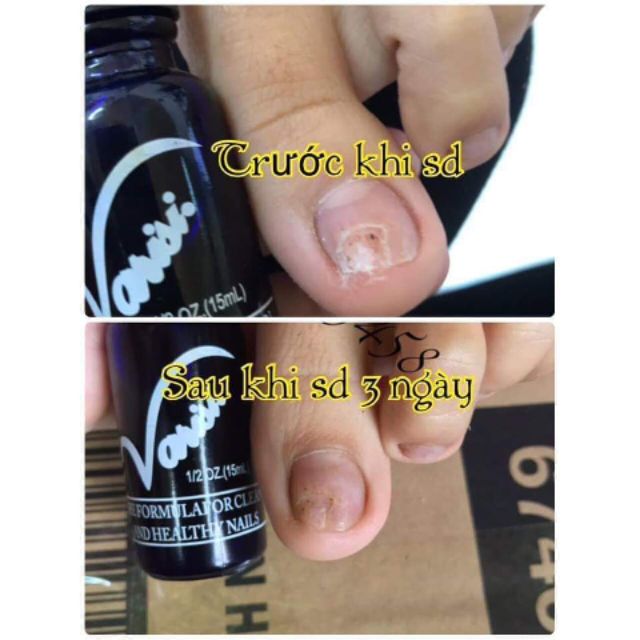 Nấm móng tay chân Varisi
