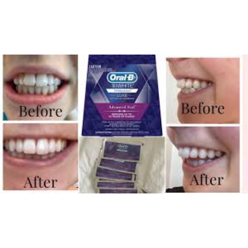 Miếng Dán Trắng Răng Oral-B 3D White Whitening Strips (28 miếng - Bill Úc)