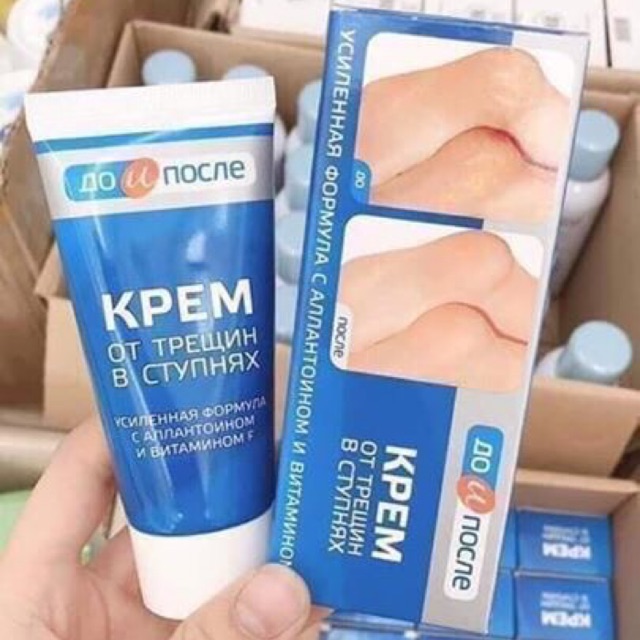 KEM TRỊ NỨT GÓT CHÂN NGA
