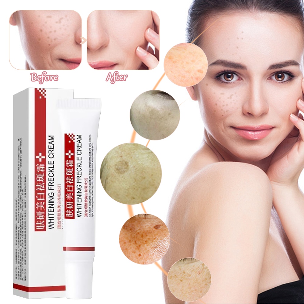 Kem dưỡng trắng da hỗ trợ giảm tàn nhang và đốm đen hiệu quả | BigBuy360 - bigbuy360.vn