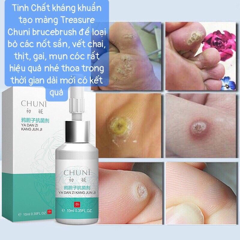 Kem bôi ngoài da hỗ trợ mụn cóc, mụn cơm, mụn mắc cá chân, mụn thịt , mụn ruồi , vết chai sần ở da dung tích 10ml