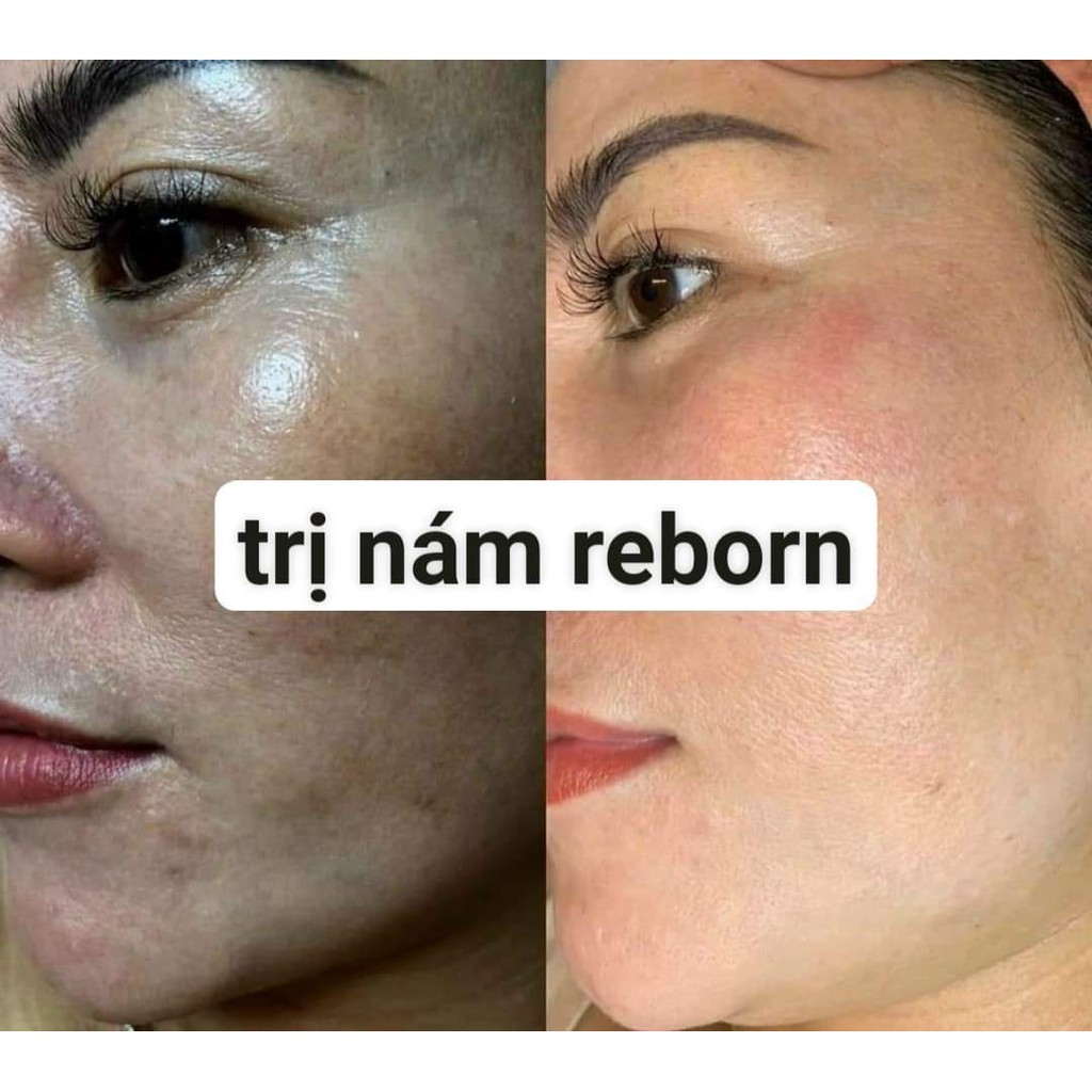 Kem Nám,Tàn Nhang,Đốm Nâu Reborn-Kem Đêm