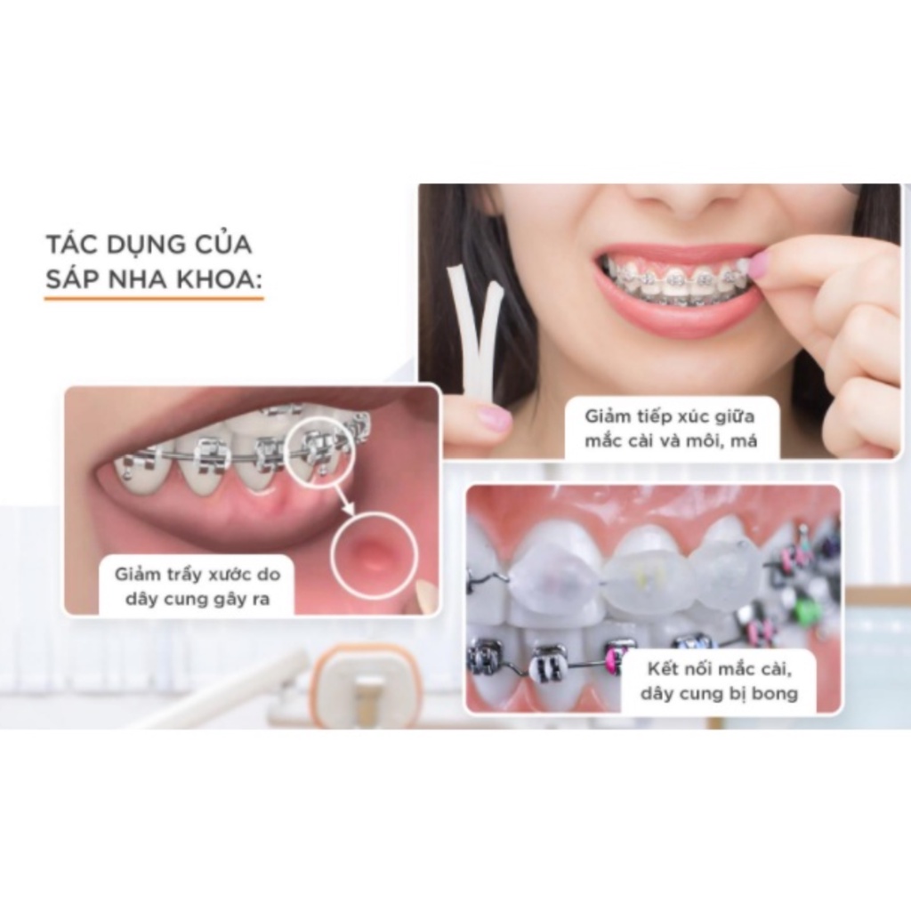 SÁP NHA KHOA, SÁP CHỈNH NHA CHO NGƯỜI NIỀNG RĂNG