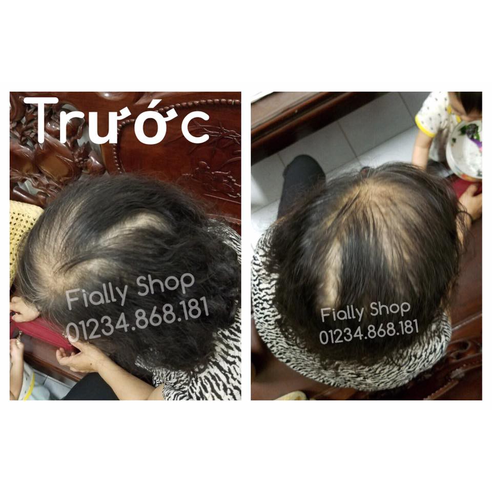 TÓC THẬT 100% - Tóc che hói, che bạc ❤️FREESHIP - che mảng hói lớn, trung niên