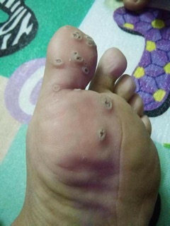 Mụn cơm, mụn cóc, mắt cá