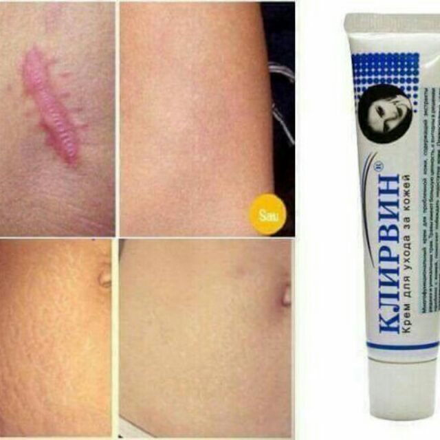 KEM TRỊ SẸO KLIRVIN NGA