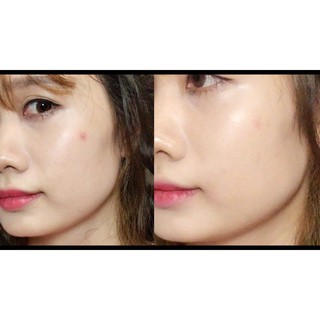 MIẾNG DÁN MỤN COSRX ACNE [SET 2 MIẾNG]