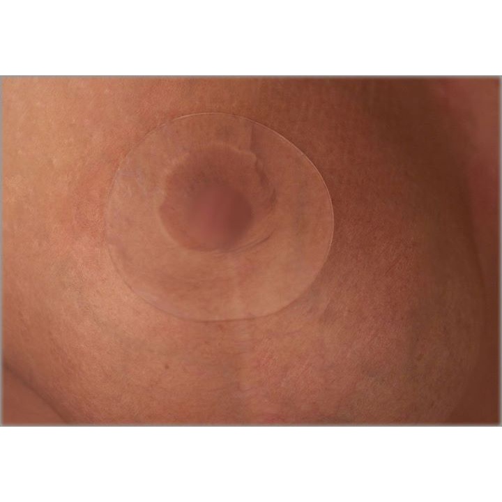 Tấm Dán Mờ Sẹo Ngực Scar Fx Circle