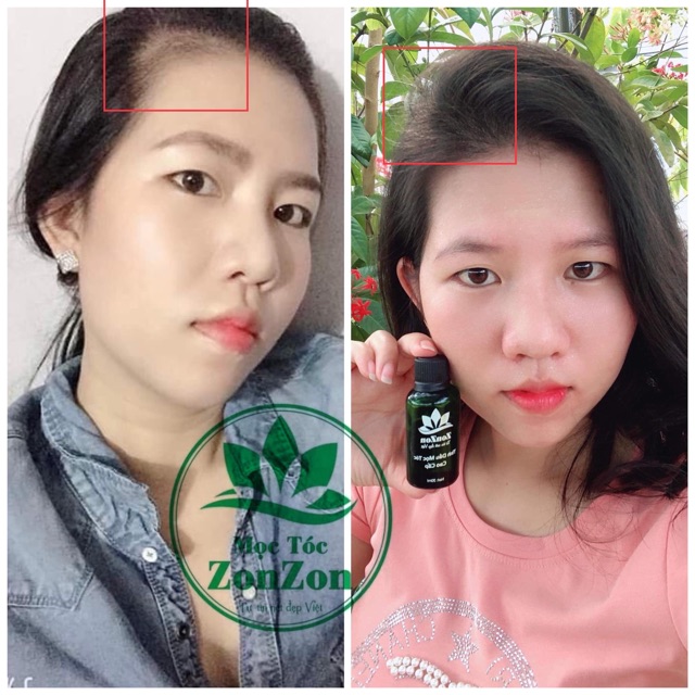 Tinh dầu mọc tóc ZonZon