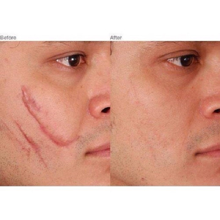 Scar Esthetique - Kem Chuyên Làm Mờ Sẹo Lõm, Sẹo Thuỷ Đậu, Sẹo Thâm Do Mụn - Phân phối chính thức