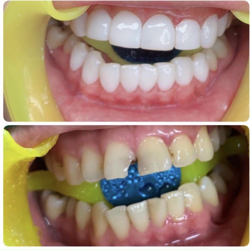 Dưỡng môi thâm loang